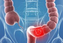 Cum a ajuns cancerul de colon să afecteze tot mai mulți tineri?