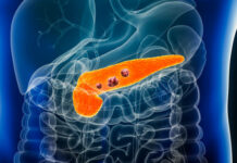 A fost găsit leacul pentru cancerul pancreatic – tratamentul care aduce speranţe