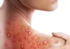 Un caz de import de infecție cu virusul variolei maimuței a fost înregistrat în Republica Moldova
