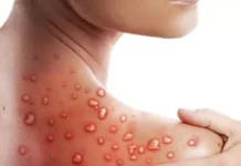 Un caz de import de infecție cu virusul variolei maimuței a fost înregistrat în Republica Moldova