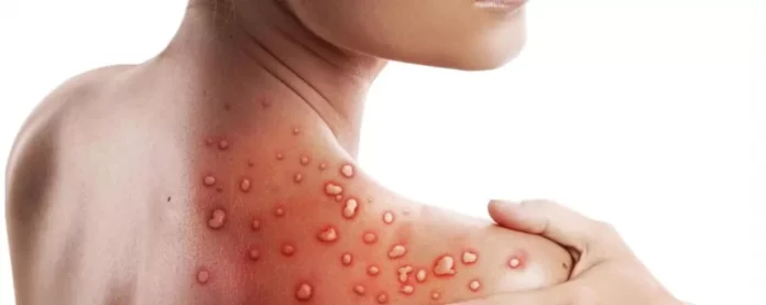 variola-maimutei-ce-este-si-cum-se-manifesta_0.jpg