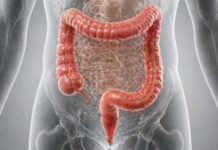 Semnele timpurii ale cancerului de colon pe care mulți le ignoră. Ce îți transmite corpul înainte să fie prea târziu