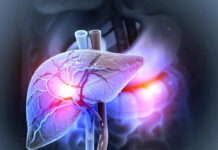 Boala ficatului gras, în creștere: 1,8 miliarde de persoane ar putea fi afectate până în 2050