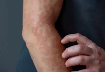 Keratina, noua piesă-cheie în lupta cu eczema și psoriazisul: studiul care schimbă felul în care privim inflamația pielii